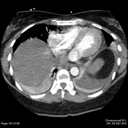 Bilateral pulmonary emboli with Hampton hump sign (Radiopaedia 54070-60246 Axial C+ CTPA 51).jpg