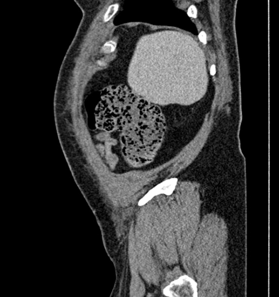 File:Bilateral rectus sheath hematomas (Radiopaedia 50778-56252 B 12).jpg