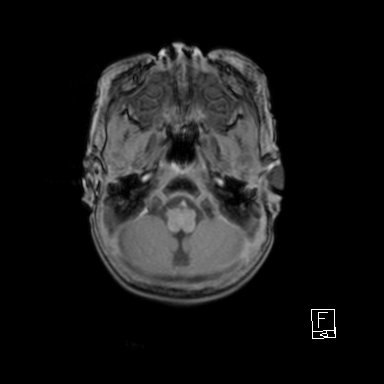 File:Bilateral subdural hemorrhage and parietal skull fracture (Radiopaedia 26058-26190 Axial T1 8).png