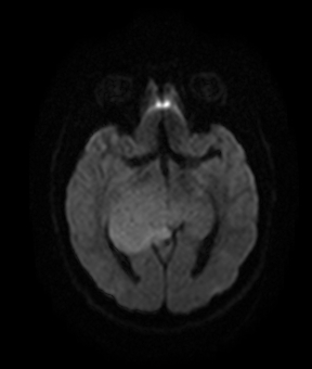 File:Bilateral thalamic gliomata (Radiopaedia 42538-45664 Axial DWI 10).jpg