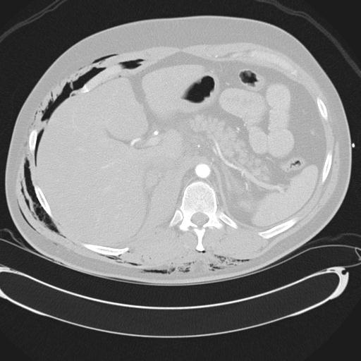Bilateral traumatic renovascular injury (Radiopaedia 32051-32995 Axial lung window 52).jpg