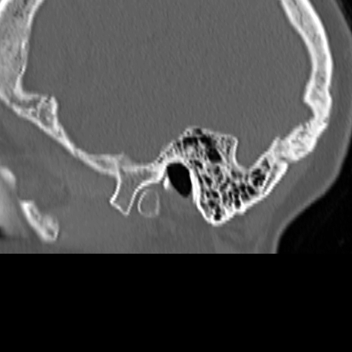 Bilateral tympanoplasty (Radiopaedia 16947-16664 Sagittal bone window 1).jpg