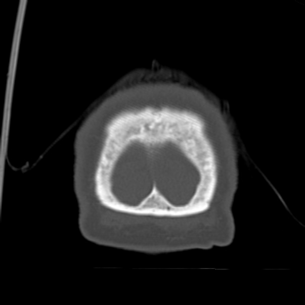 Biparietal osteodystrophy (Radiopaedia 46109-50463 Coronal bone window 102).jpg