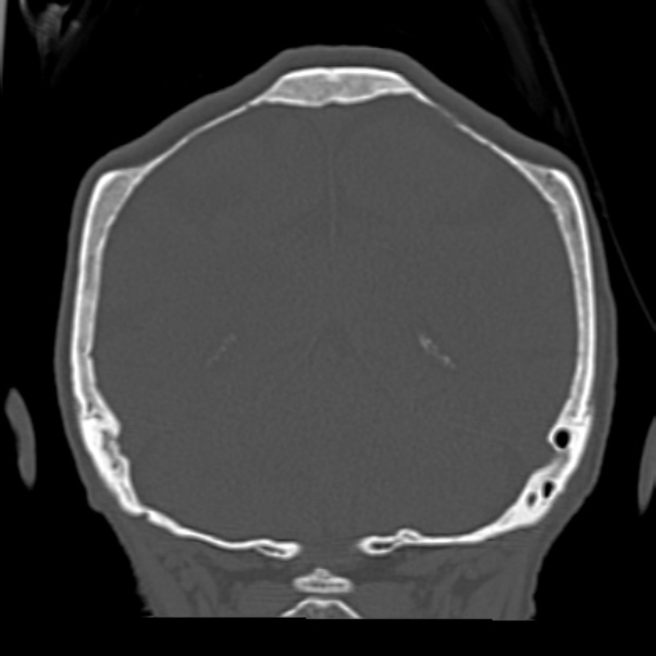 Biparietal osteodystrophy (Radiopaedia 46109-50463 Coronal bone window 79).jpg
