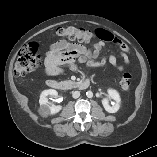 File:Bladder papillary urothelial carcinoma (Radiopaedia 48119-52951 Axial 23).png