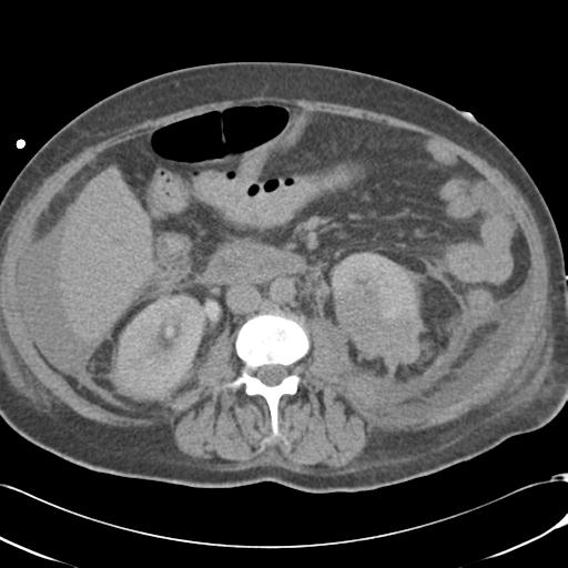 Bladder rupture post renal biopsy (Radiopaedia 30863-31572 Axial non-contrast 43).jpg