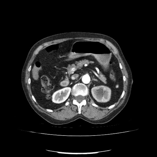 File:Bladder tumor detected on trauma CT (Radiopaedia 51809-57609 A 96).jpg