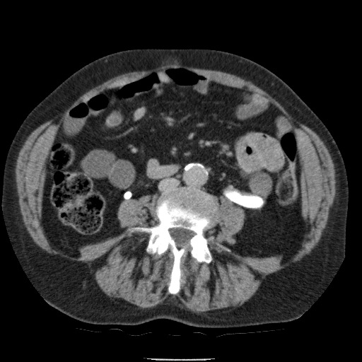 Bladder tumor detected on trauma CT (Radiopaedia 51809-57609 C 77).jpg