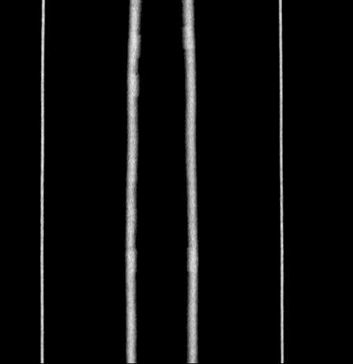 Blind-ending branch of a bifid ureter (Radiopaedia 61159-69048 C 79).jpg