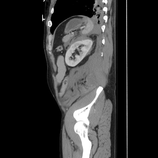 Blunt abdominal trauma with solid organ and musculoskelatal injury with active extravasation (Radiopaedia 68364-77895 C 112).jpg