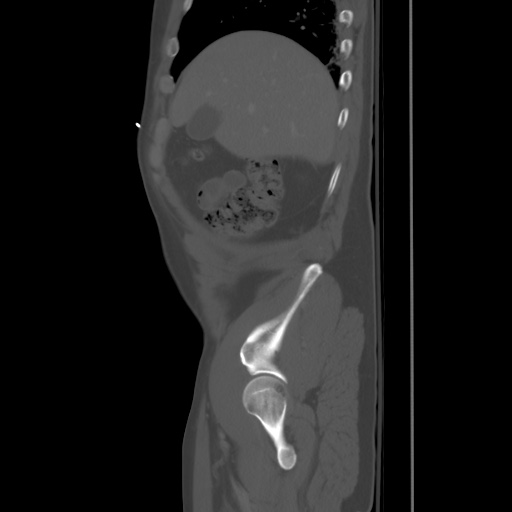 Blunt abdominal trauma with solid organ and musculoskelatal injury with active extravasation (Radiopaedia 68364-77895 Sagittal bone window 13).jpg