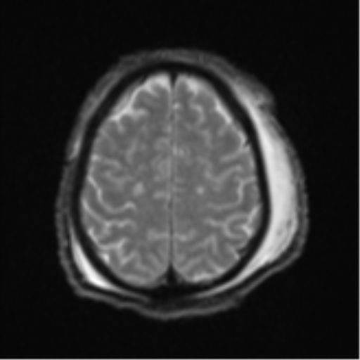 Blunt cerebrovascular injury (Radiopaedia 53682-59745 Axial DWI 24).png