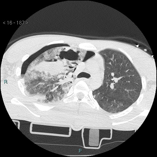 Blunt chest trauma (Swiss cheese sign) (Radiopaedia 38519-40618 Axial lung window 23).jpg