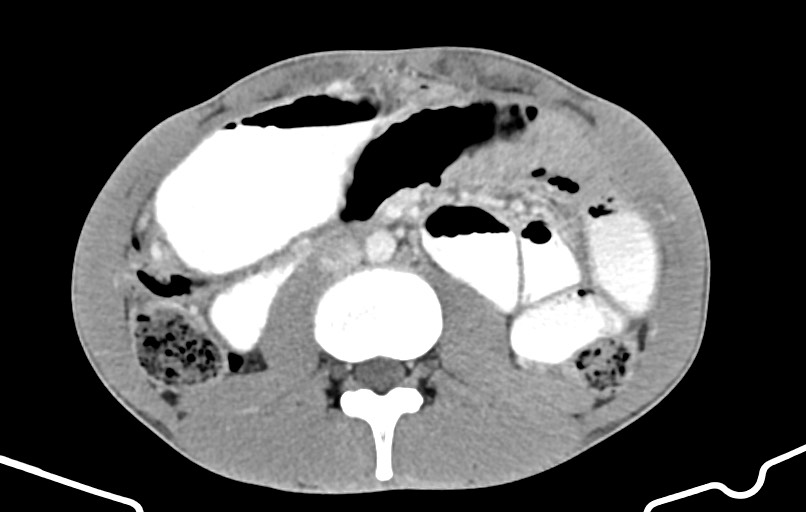 Blunt injury to the small bowel (Radiopaedia 74953-85987 A 87).jpg