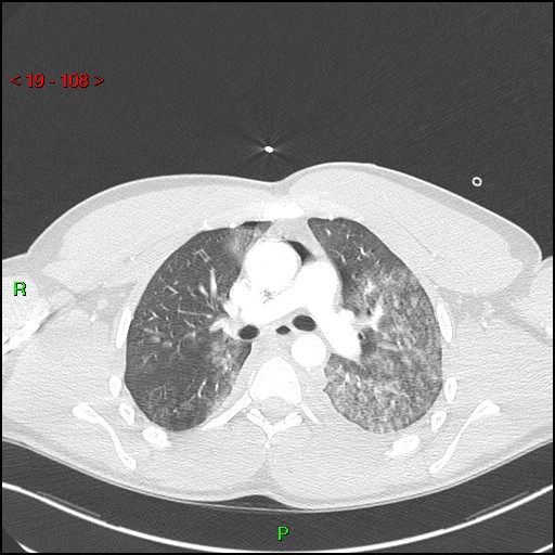 File:Blunt thoracic trauma (Radiopaedia 73454-84221 Axial lung window 40).jpg