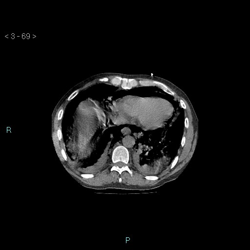 Boerhaave syndrome (Radiopaedia 27683-27897 Axial non-contrast 69).jpg