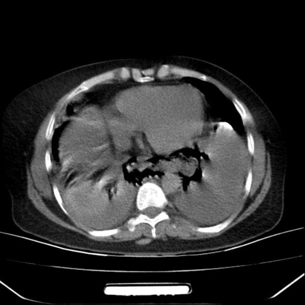 Boerhaave syndrome (Radiopaedia 45644-49799 Axial non-contrast 50).jpg