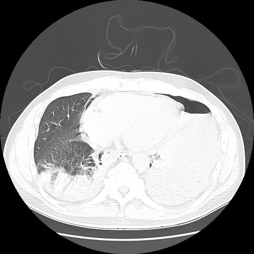 Boerhaave syndrome (Radiopaedia 59796-67310 Axial lung window 45).jpg