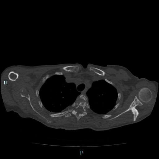 File:Bone metastases from untreated breast cancer (Radiopaedia 42973-46219 Axial bone window 23).jpg