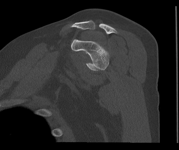 Bony Bankart and Hill-Sachs lesions (Radiopaedia 33622-34727 Sagittal bone window 32).png