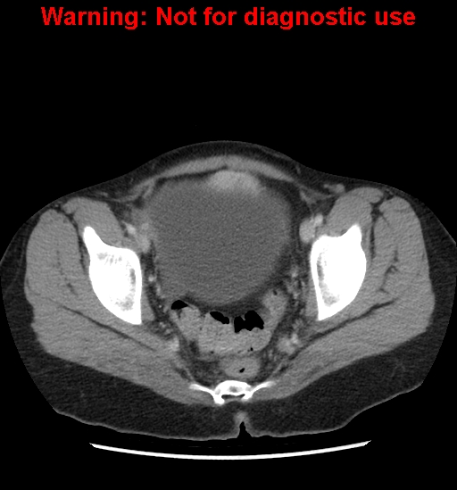 Borderline mucinous cystadenoma of ovary (Radiopaedia 25586-25767 A 102).jpg