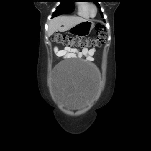 Borderline mucinous tumor (ovary) (Radiopaedia 78228-90808 C 13).jpg