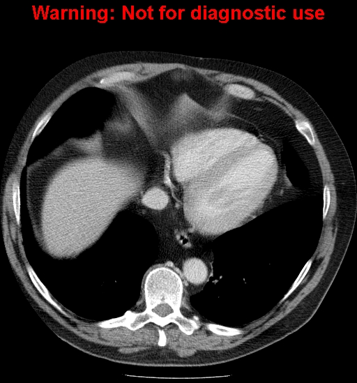File:Bosniak renal cyst - type IV (Radiopaedia 23402-23466 D 4).jpg