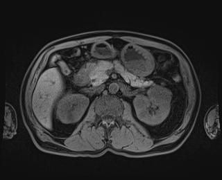 Bouveret syndrome (Radiopaedia 61017-68856 Axial T1 fat sat 38).jpg