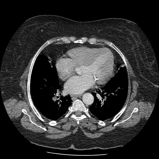 Bovine aortic arch - right internal mammary vein drains into the superior vena cava (Radiopaedia 63296-71875 A 92).jpg