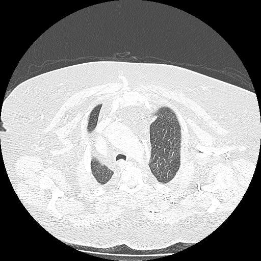 Bovine aortic arch - right internal mammary vein drains into the superior vena cava (Radiopaedia 63296-71875 Axial lung window 29).jpg