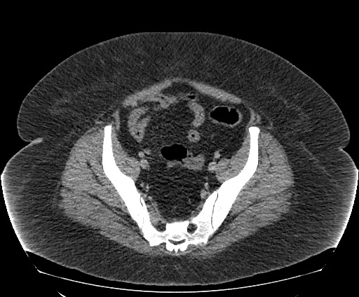 File:Bowel and splenic infarcts in acute lymphocytic leukemia (Radiopaedia 61055-68913 A 103).jpg