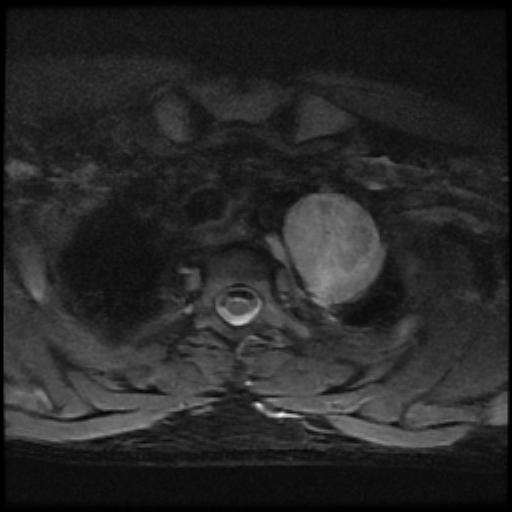 File:Brachial plexus neurofibroma (Radiopaedia 28030-28291 Axial STIR 8).png