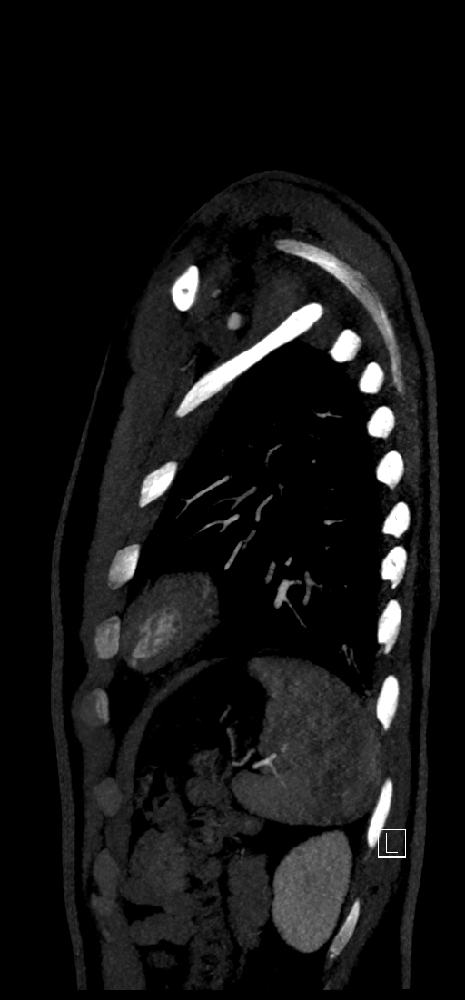 Brachiocephalic trunk pseudoaneurysm (Radiopaedia 70978-81191 C 77).jpg
