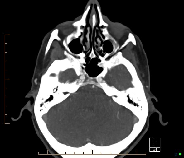 Brachiocephalic trunk stenosis (Radiopaedia 87242-103519 A 51).jpg