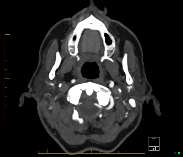 Brachiocephalic trunk stenosis (Radiopaedia 87242-103519 A 67).jpg