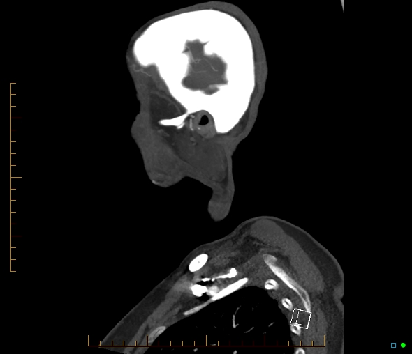 Brachiocephalic trunk stenosis (Radiopaedia 87242-103519 C 62).jpg