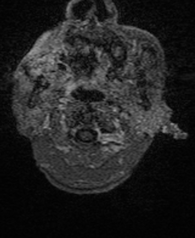 Brain abscess with dual rim sign (Radiopaedia 87566-103938 Axial T1 C+ 6).jpg