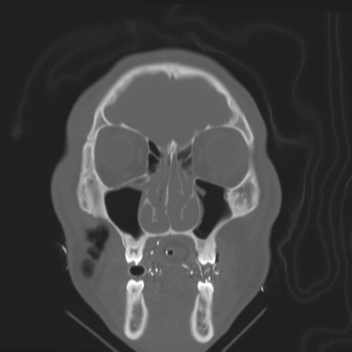 Brain contusions, internal carotid artery dissection and base of skull fracture (Radiopaedia 34089-35339 Coronal bone window 18).png