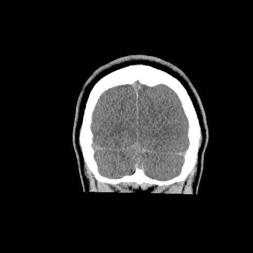Brain death (Radiopaedia 78597-91360 Coronal non-contrast 67).jpg
