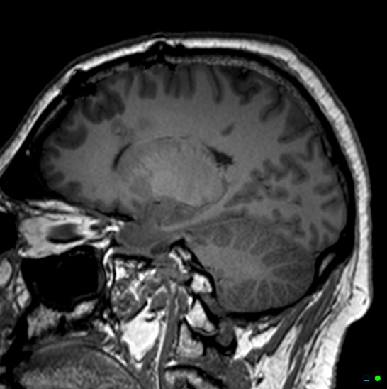 Brain death on MRI and CT angiography (Radiopaedia 42560-45689 Sagittal T1 43).jpg
