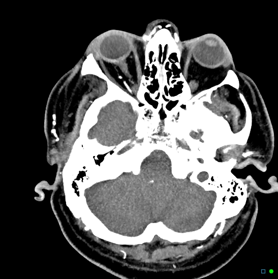 Brain death on MRI and CT angiography (Radiopaedia 42560-45841 B 41).jpg
