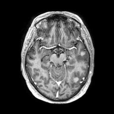 Brain metastases from lung cancer (Radiopaedia 83839-99028 Axial T1 C+ 24).jpg