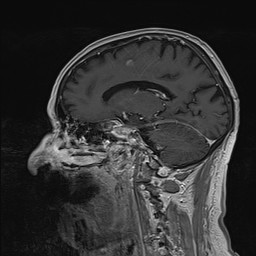 Brain metastasis (Radiopaedia 42617-45761 Sagittal T1 C+ 59).jpg