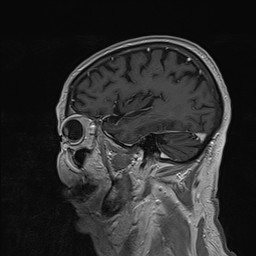 Brain metastasis (Radiopaedia 42617-45761 Sagittal T1 C+ 74).jpg