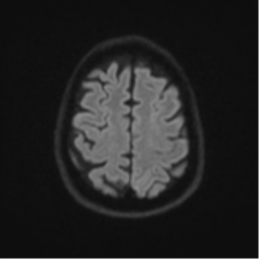 File:Brain metastasis (large cystic mass) (Radiopaedia 47497-52107 Axial DWI 50).png