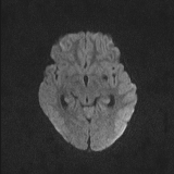 Brainstem glioma (Radiopaedia 67531-76922 Axial DWI 58).jpg