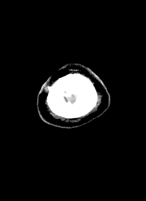 Brainstem hemorrhage (Radiopaedia 81294-94976 Axial non-contrast 4).jpg