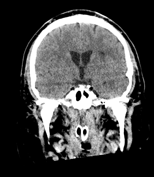 Brainstem hemorrhage (Radiopaedia 81294-94976 Coronal non-contrast 32).jpg