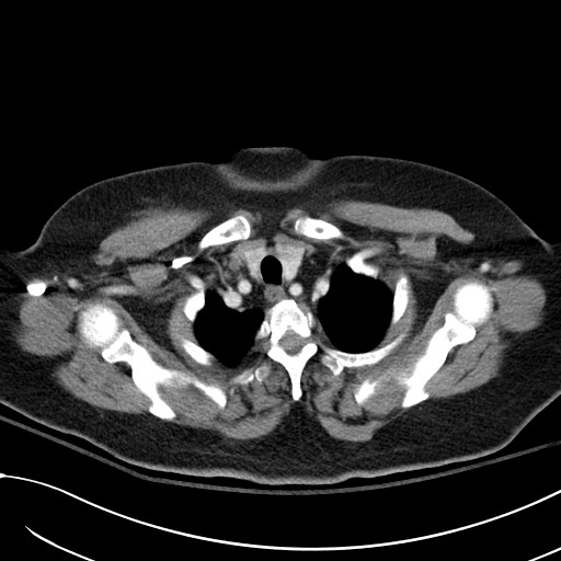 File:Breast carcinoma with pathological hip fracture (Radiopaedia 60314-67974 A 8).jpg