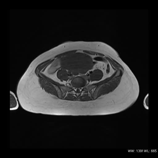 File:Broad ligament fibroid (Radiopaedia 49135-54241 Axial T1 6).jpg